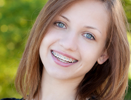 When Do I Get My Braces Off? – DelliGatti and Milewski Orthodontic Group